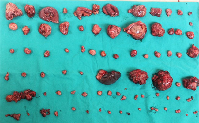 Bóc gần 100 khối u, nhiều khối đã vỡ trong ổ bụng 1 nam giới