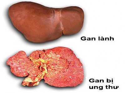 Điểm khác nhau giữa gan lành và gan bị ung thư.