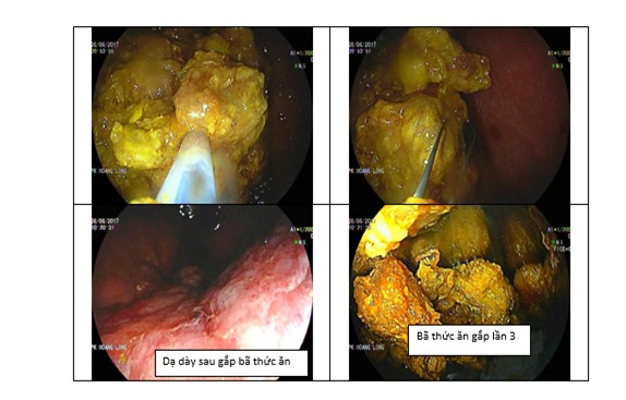 Cảnh báo: Uống tinh bột nghệ không đúng cách gây tắc ruột - Ảnh 1.