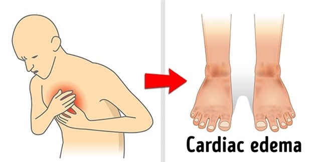 Đừng bỏ qua 8 nguyên nhân nghiêm trọng khiến cơ thể bạn bị sưng phù chỗ này chỗ kia - Ảnh 6.