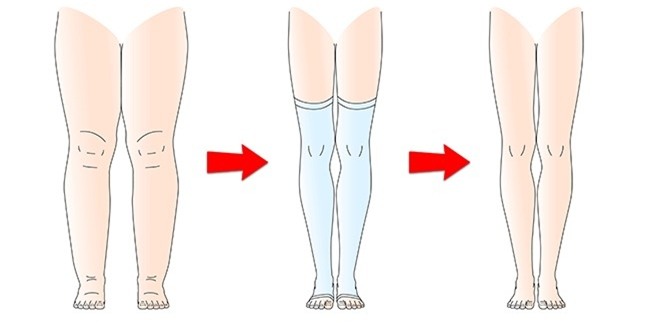 Đừng bỏ qua 8 nguyên nhân nghiêm trọng khiến cơ thể bạn bị sưng phù chỗ này chỗ kia - Ảnh 8.