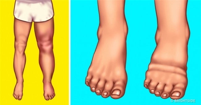 Đừng bỏ qua 8 nguyên nhân nghiêm trọng khiến cơ thể bạn bị sưng phù chỗ này chỗ kia - Ảnh 1.