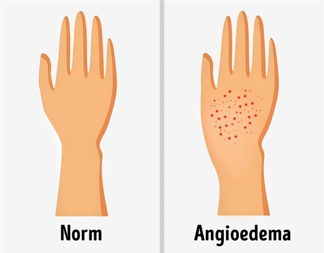 Đừng bỏ qua 8 nguyên nhân nghiêm trọng khiến cơ thể bạn bị sưng phù chỗ này chỗ kia - Ảnh 3.