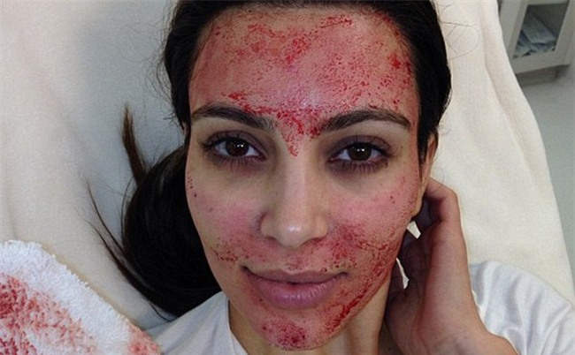 Tiêm tế bào gốc 