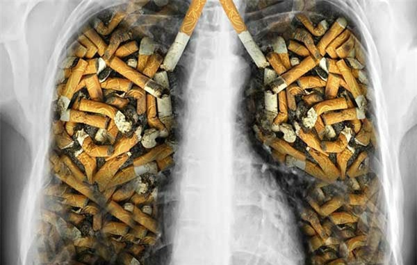 ung thư, bệnh ung thư