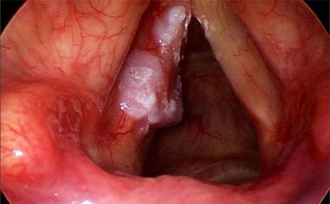 GĐ BV Tai Mũi Họng: Bất kỳ ai có dấu hiệu này 5 - 7 ngày không đỡ phải đi khám ung thư ngay