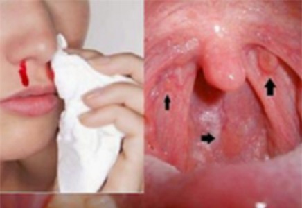 Ung thư vòm họng - 1 bệnh ung thư đứng đầu ở VN: 3 dấu hiệu phát hiện bệnh sớm cần nhớ - Ảnh 1.