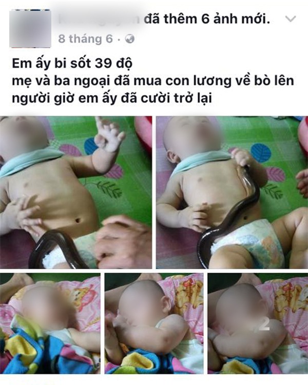 Hạ sốt bằng lươn: Sốt chưa hạ trẻ đã phải đối mặt với nguy cơ nhiễm trùng da - Ảnh 1.