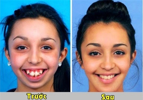 loat anh truoc - sau cua sao viet cho thay suc manh ghe gom cua viec chinh rang - 11