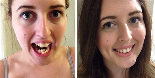 loat anh truoc - sau cua sao viet cho thay suc manh ghe gom cua viec chinh rang - 12