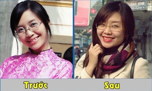 loat anh truoc - sau cua sao viet cho thay suc manh ghe gom cua viec chinh rang - 14