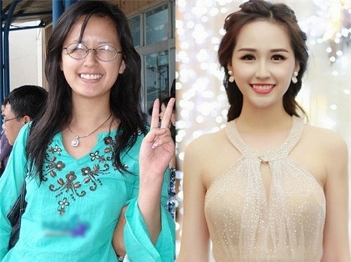 loat anh truoc - sau cua sao viet cho thay suc manh ghe gom cua viec chinh rang - 2