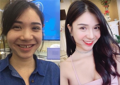 loat anh truoc - sau cua sao viet cho thay suc manh ghe gom cua viec chinh rang - 6