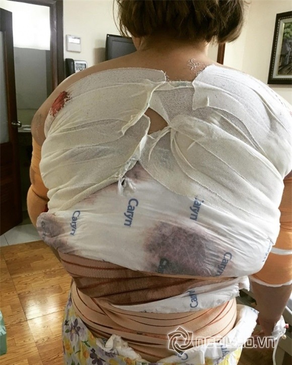 Ngô Thủy Tiên, diễn viên Ngô Thủy Tiên, Ngô Thủy Tiên cắt mỡ, Ngô Thủy Tiên phẫu thuật thẩm mỹ