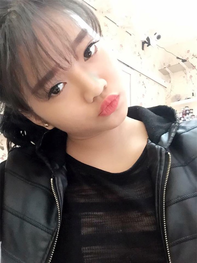 Muốn làm duyên bằng má lúm đồng tiền nhân tạo, cô gái trẻ bị áp-xe, má sưng như quả trứng - Ảnh 1.