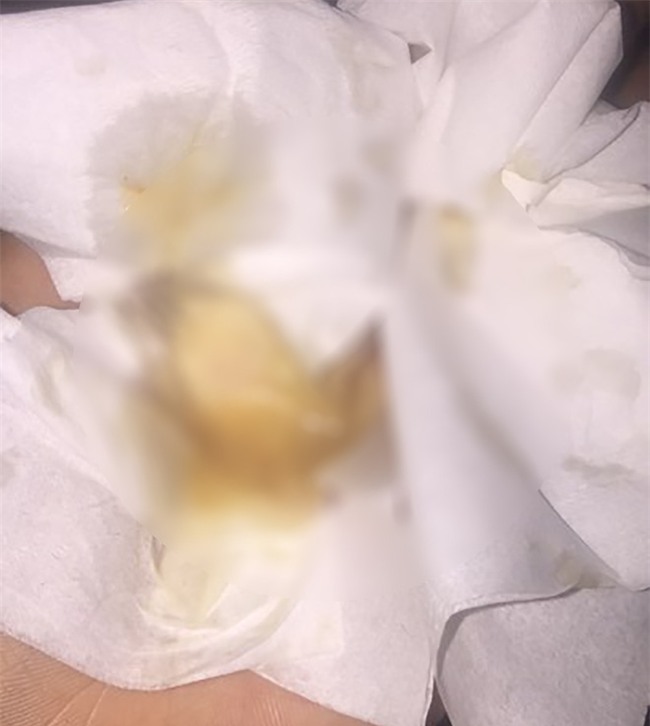 Muốn làm duyên bằng má lúm đồng tiền nhân tạo, cô gái trẻ bị áp-xe, má sưng như quả trứng - Ảnh 8.