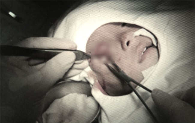 viêm xoang, biến chứng viêm xoang, bệnh nhi