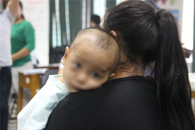 viêm xoang, biến chứng viêm xoang, bệnh nhi