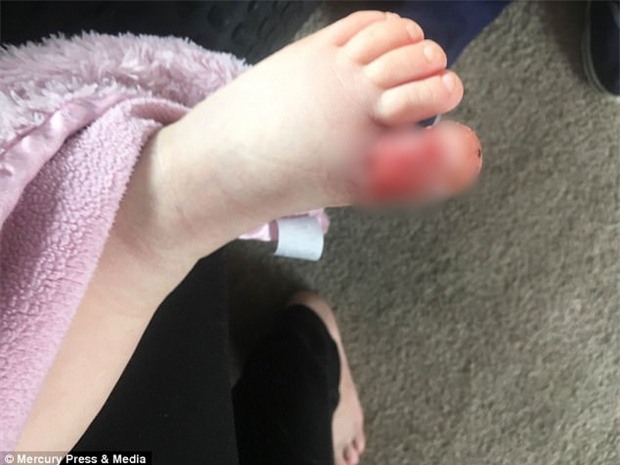 Giẫm phải nước tiểu của chó trên bãi biển, em bé 8 tháng tuổi phải cắt bỏ gần hết một ngón chân - Ảnh 1.