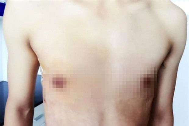 Tiếp nạp nhiều đồ ăn nhanh, chàng trai 19 tuổi mọc ti lệch một bên - Ảnh 3.