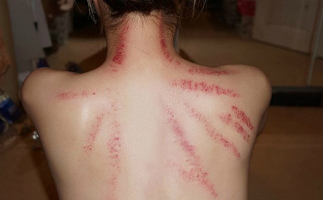 Người bệnh bị sốt xuất huyết có nên xông hơi, cạo gió?