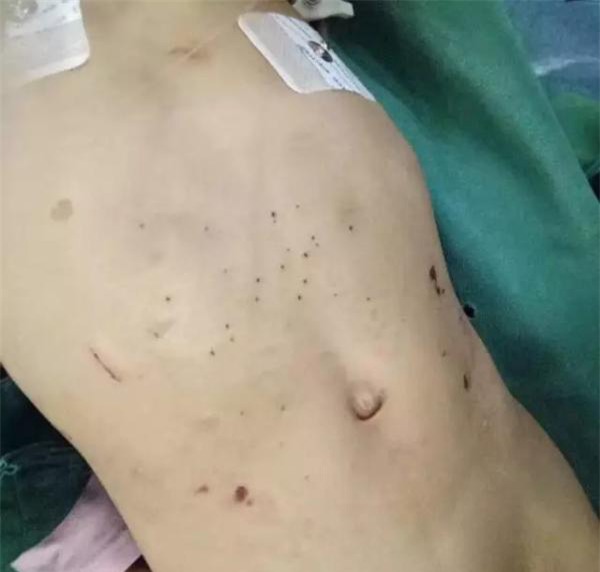 be gai 3 tuoi bi bong da dau, kim dam chi chit o bung tu nhung lan tra tan da man cua me ke - 2