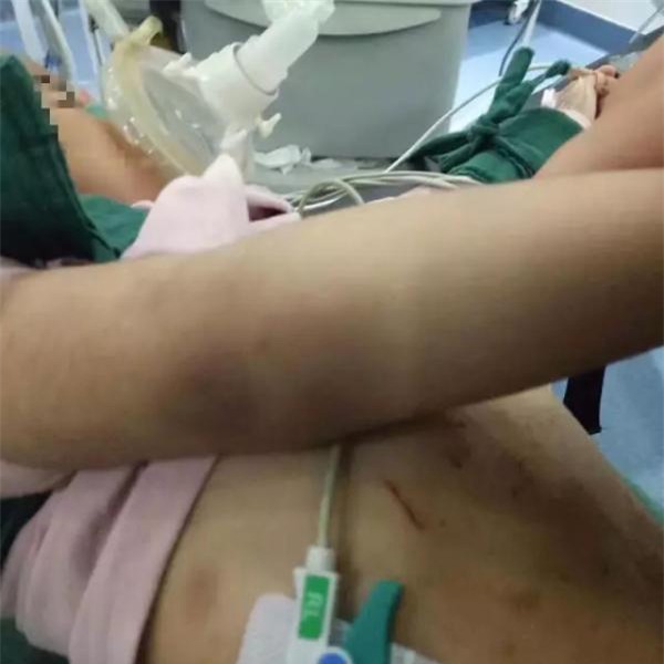 be gai 3 tuoi bi bong da dau, kim dam chi chit o bung tu nhung lan tra tan da man cua me ke - 4