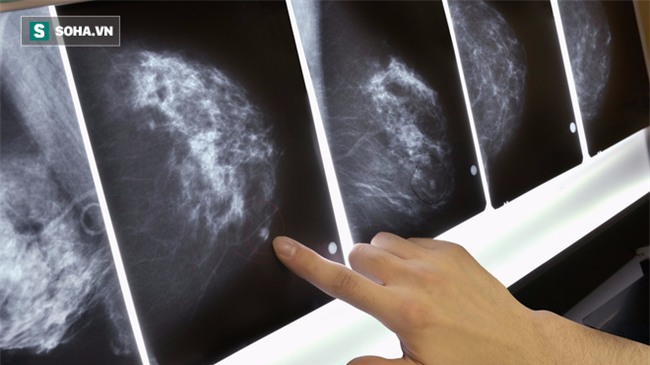 Mô bào đặc ở vú: Phụ nữ có càng nhiều, nguy cơ ung thư vú càng cao - Ảnh 1.