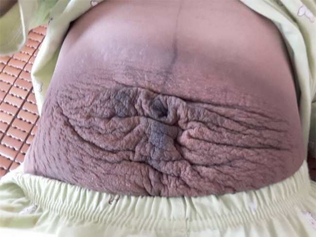 Bà mẹ 24 tuổi chia sẻ vết tích bụng rạn 13 ngày sau sinh nhìn đến xót xa - Ảnh 1.