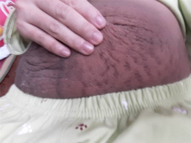 Bà mẹ 24 tuổi chia sẻ vết tích bụng rạn 13 ngày sau sinh nhìn đến xót xa - Ảnh 2.