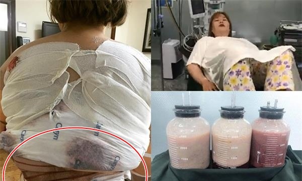 Á quân 'Bước nhảy ngàn cân' Thủy Tiên đại phẫu lần 2, hút 8 lít mỡ khiến ai nhìn cũng shock-1