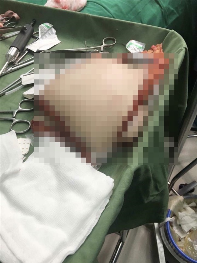 Á quân 'Bước nhảy ngàn cân' Thủy Tiên đại phẫu lần 2, hút 8 lít mỡ khiến ai nhìn cũng shock-4