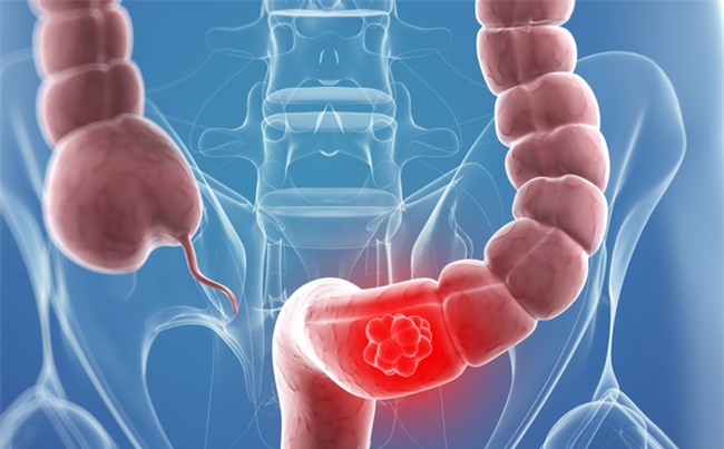 Ung thư đại tràng thường phát hiện muộn: Đột phá nhờ xét nghiệm máu?