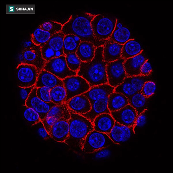 Ung thư đại tràng thường phát hiện muộn: Đột phá nhờ xét nghiệm máu? - Ảnh 1.