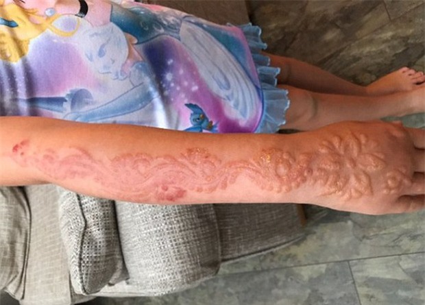 Xăm henna ở tay trong chuyến du lịch Ai Cập, bé gái nhận hậu quả khủng khiếp - Ảnh 2.