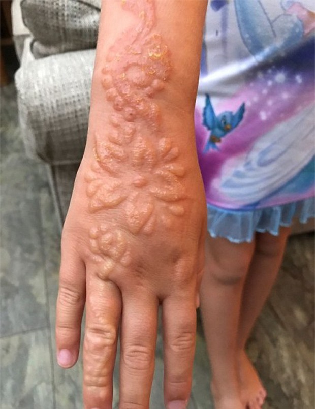 Xăm henna ở tay trong chuyến du lịch Ai Cập, bé gái nhận hậu quả khủng khiếp - Ảnh 3.