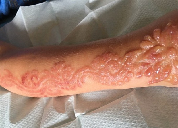 Xăm henna ở tay trong chuyến du lịch Ai Cập, bé gái nhận hậu quả khủng khiếp - Ảnh 4.