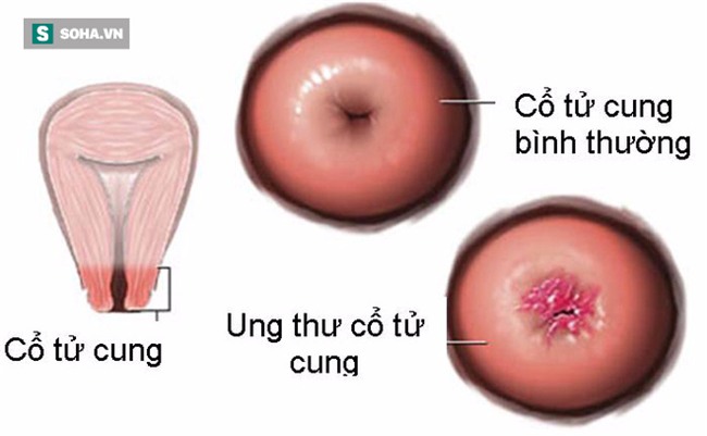 32 tuổi tử vong vì bệnh ung thư vì ngại khám phụ khoa: Lời cảnh báo cho tất cả chị em - Ảnh 2.