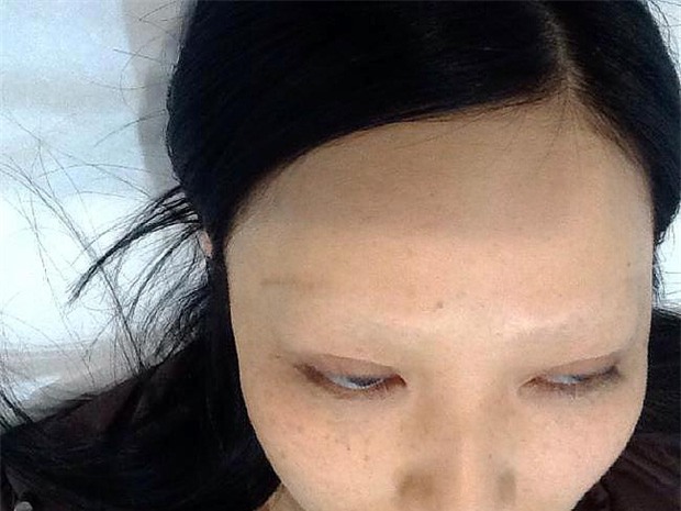 Xóa xăm lông mày, cô gái bàng hoàng khi chứng kiến cặp lông mày của mình trụi húi - Ảnh 2.