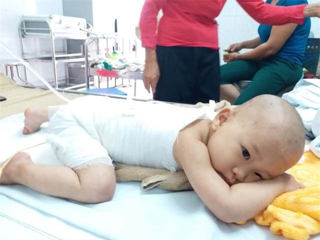 con gai 16 thang tuoi bi bong, me boi kem danh rang lam mat nhan cai ket dau long - 1