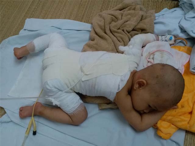 con gai 16 thang tuoi bi bong, me boi kem danh rang lam mat nhan cai ket dau long - 4