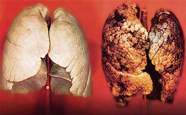 Ung thư di căn giai đoạn 4, phổi đen như bồ hòng gác bếp vì làm điều này hơn 30 năm