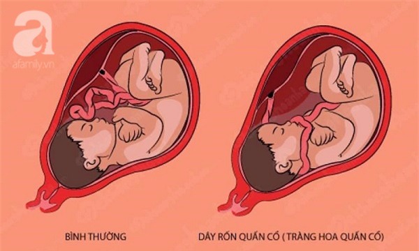 Giải mã hiện tượng dây rốn quấn cổ thai nhi khiến nhiều mẹ bầu lo lắng - Ảnh 2.