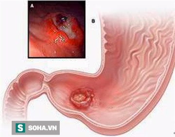 Nếu có dấu hiệu sau cần đi khám ngay, để muộn có thể bị thủng dạ dày - Ảnh 2.