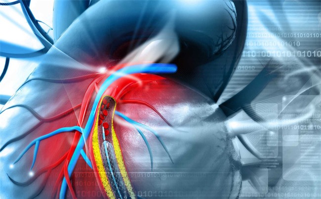 Bệnh mạch vành có thể khiến bạn nhồi máu cơ tim: Những triệu chứng phải để ý ngay kẻo muộn