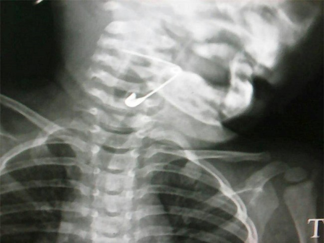 Gap thanh cong kim bang dai hon 3 cm trong thanh quan be gai hinh anh 1