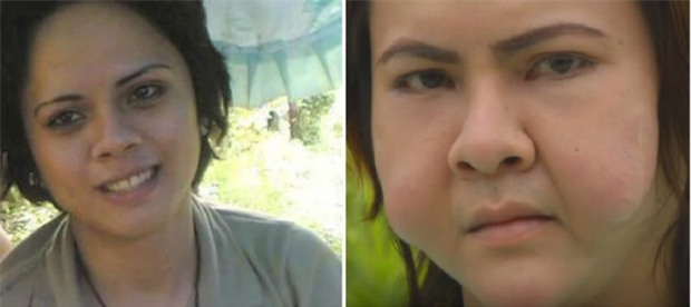 Hội bạn thân bị biến dạng mặt nghiêm trọng vì ham làm đẹp bằng phương pháp tiêm filler giá rẻ - Ảnh 5.