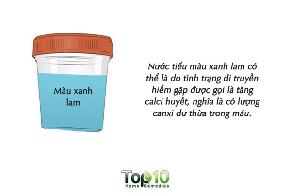 Màu sắc của nước tiểu cảnh báo tình trạng sức khỏe của bạn - Ảnh 8.