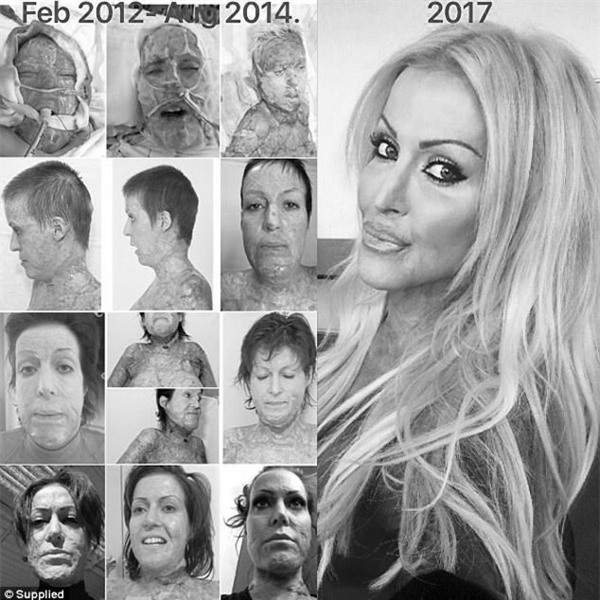 loi ke hai hung cua co gai bi nguoi la thieu song nhu ngon duoc vi... danh ghen nham - 2