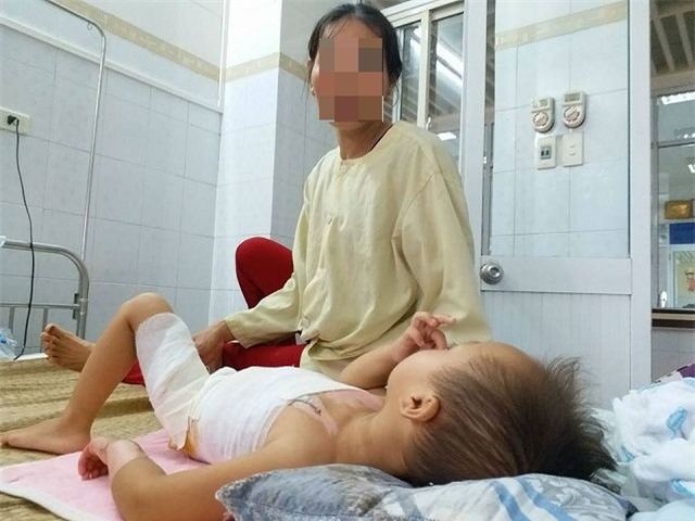 be gai 23 thang tuoi bi bong nang vi ba pha my tom de canh mep ban - 1